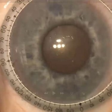 Complex and Dense Cataract